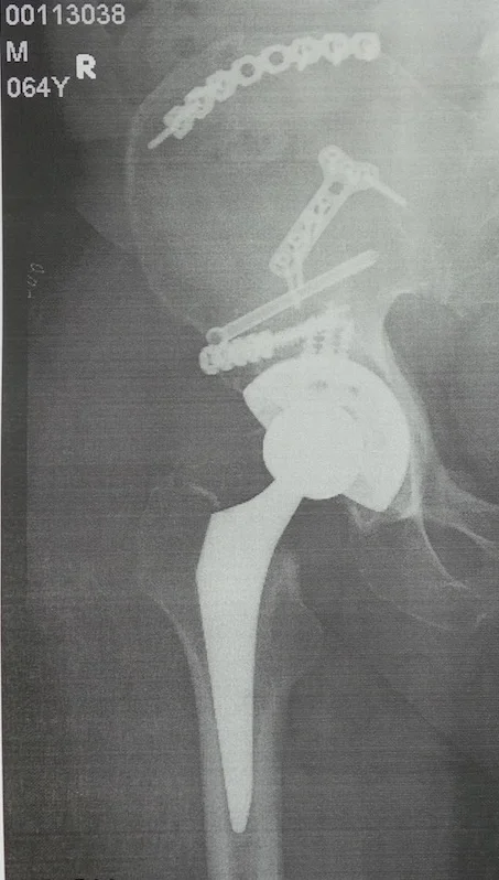 artificial hip.webp