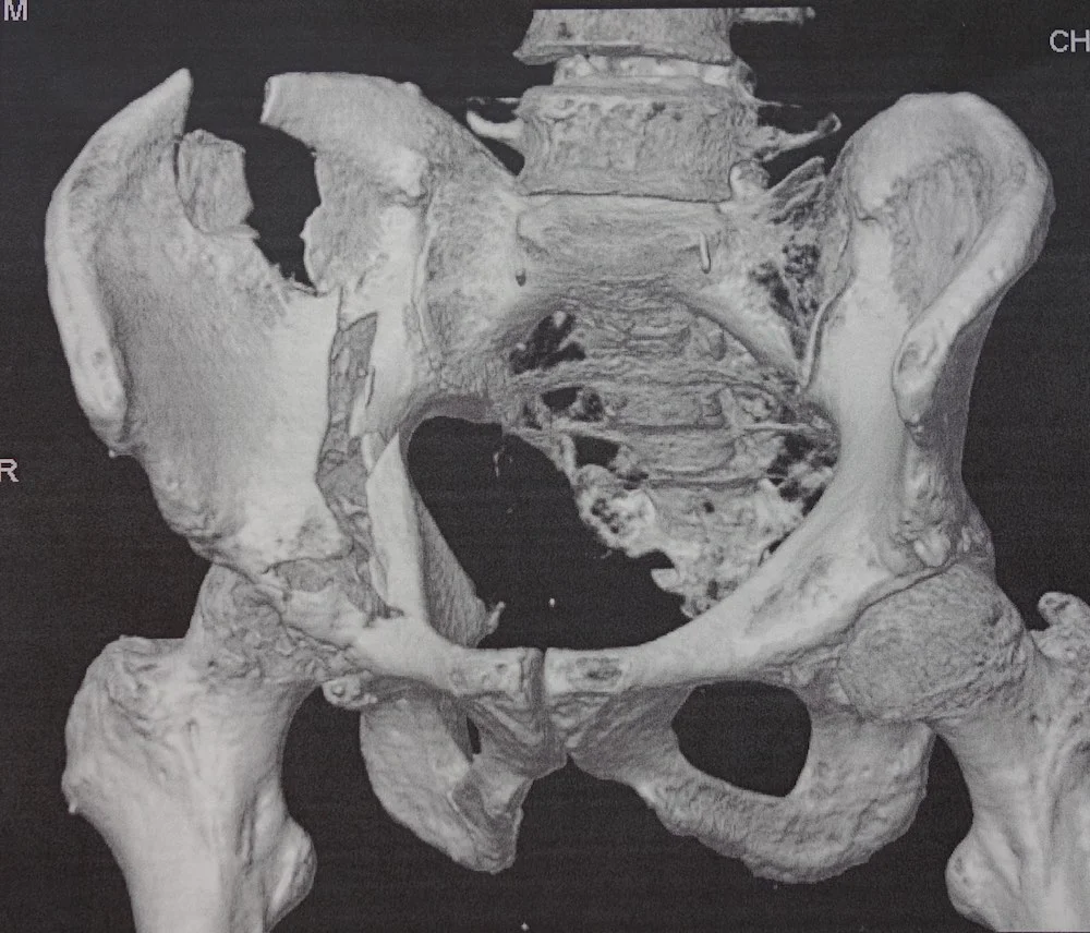 pelvis-broken.webp