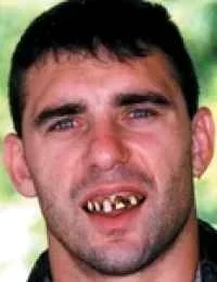 Billy_Bob_Teeth_W_Gold_Tooth.webp