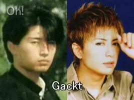 gackt plastic surgery.webp